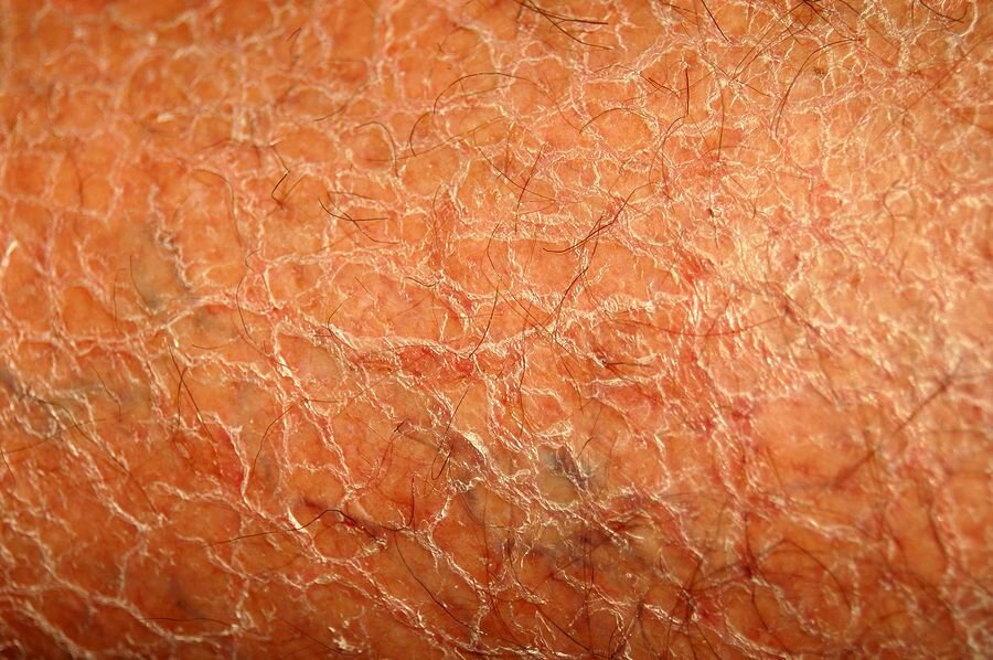 Причины сухой кожи всего тела
