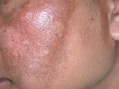 Причины появления жирной кожи на лице