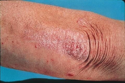 Причины возникновения сухой кожи на логтях